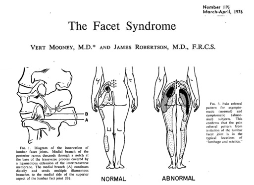 Artigo de 1976 demonstrando imagens da dor facetaria e área de irradiação da dor.