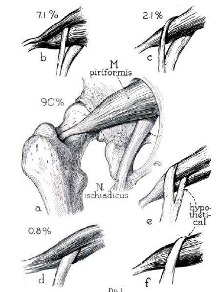 Fig 3. Relação entre músculo piriforme e nervo ciático. a)Único e posterior, b)Dividido através e abaixo, c)Dividido acima e abaixo, d)Único entre as cabeças dos músculos, e)Dividido através e acima, f)Único acima.