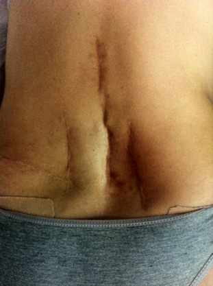 Figura 5. Figura mostrando várias incisões na coluna devido diagnóstico impreciso e consequentemente, tratamento inadequado.