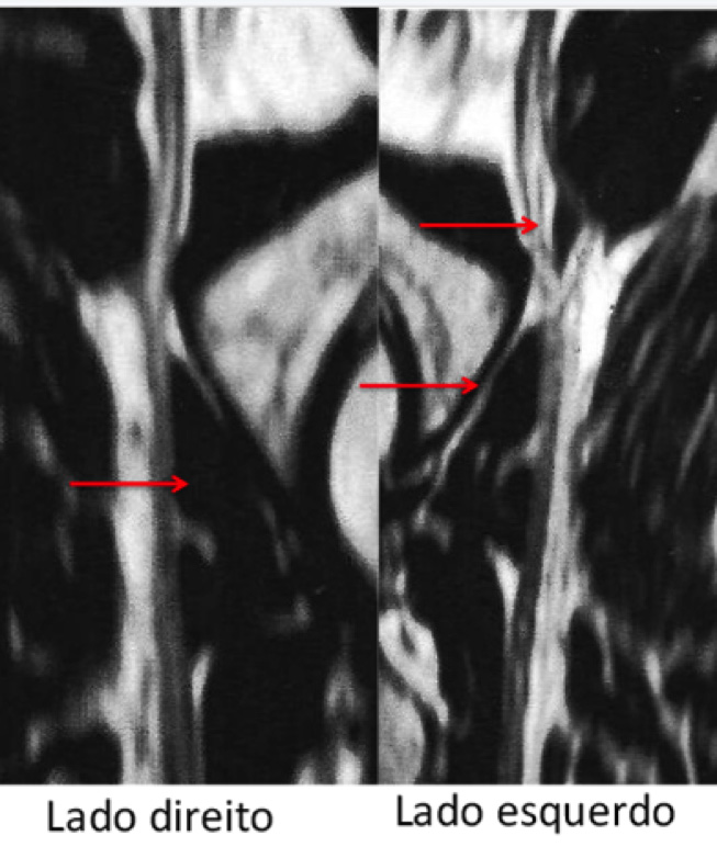 Fig 8. Observe na neurografia por Ressonância magnética a diferença entre os 2 lados: no lado direito, toda massa do músculo piriforme está somente de um lado; enquanto que do lado esquerdo, 2/3 estão de um lado e 1/3 do outro, mostrando claramente uma fenda no nervo, o que explica o quadro clínico.