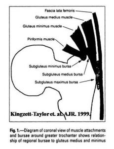 Diagram of coronal view of muscle attachments and bursae around greater trochanter shows relationship of regional bursae to gluteus medius and minimus