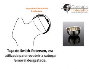 Taça de Smith-Petersen, era utilizada para recobrir a cabeça femoral desgastada