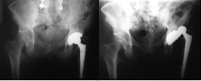 Aspecto da luxação em uma radiografia