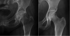 Aspecto da osteoporose: observe na radiografia da esquerda como o osso aparece menos, por ser mais rarefeito.