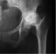 Figura 6a: Aspecto de radiografia mostrando artrose avançada com perda total do espaço articular