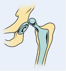 Figura 15. Ilustração de luxação de prótese
