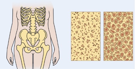 Imagem ilustrativa do osso normal e osteoporótico
