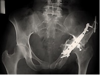 Radiografia de artrose pós-traumática: mesmo com a tentativa de fixação de uma fratura acetabular ocorreu a artrose