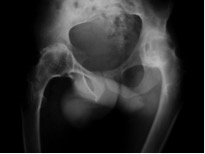 Radiografia de espondilite anquilosante: note que a articulação fundiu uma na outra pela espondilite anquilosante.