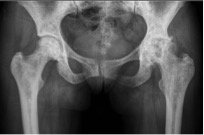 Radiografia de necrose avascular da cabeça femoral causada pela anemia falciforme