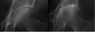 Radiografia do quadril com osteoartrose