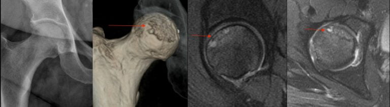 Necrose Avascular Da Cabeça Femoral - Cirurgia, Tratamento E ...