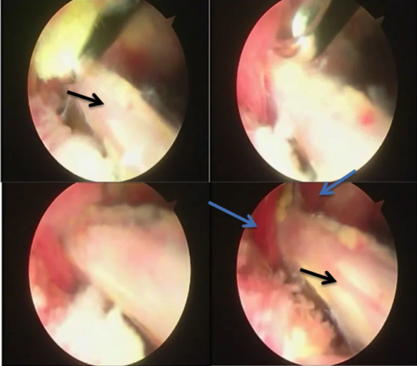 Figura 9. Endoscopia periarticular evidenciando na flecha preta o nervo ciático e com a flecha azul o musculo piriforme. Observe que na última imagem é evidente a musculatura atravessando o nervo pelo meio.