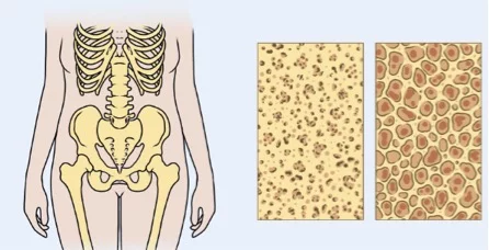 Imagem ilustrativa do osso normal e osteoporótico