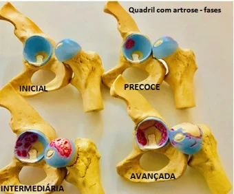 Quadril com artrose - fases